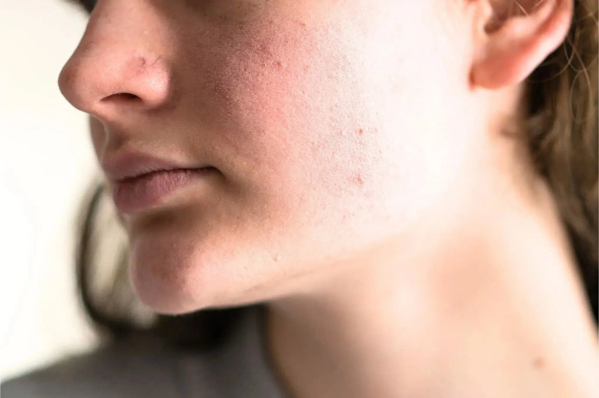 Why So Many Women Today Have Pitta Skin