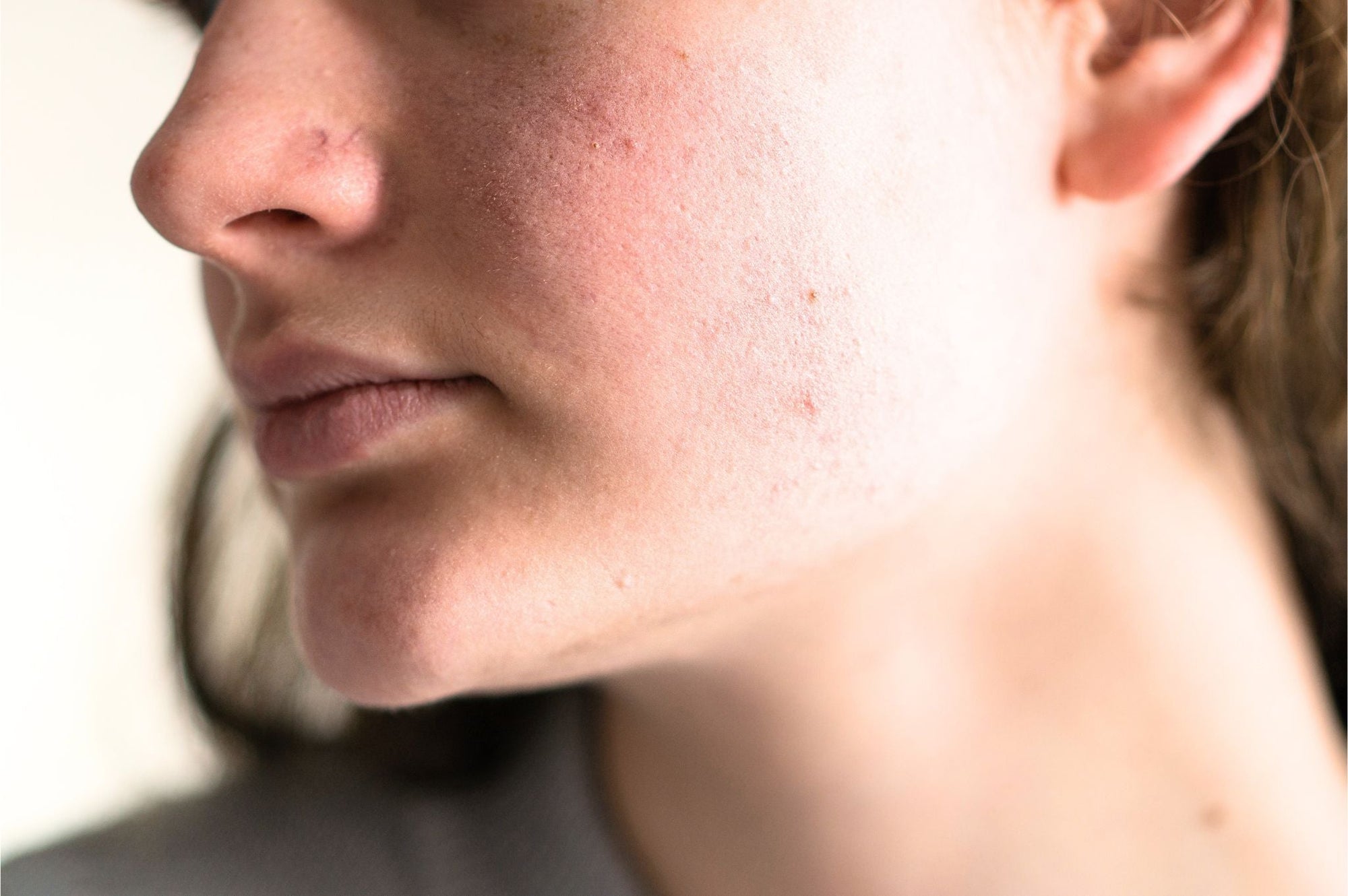 Why So Many Women Today Have Pitta Skin